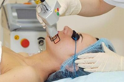tipos de rejuvenescimento da pele facial a laser